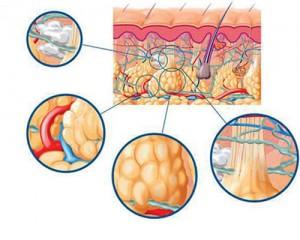 ¿Cómo se desarrolla la celulitis?