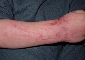 Tratamientos Para la Dermatitis Atópica